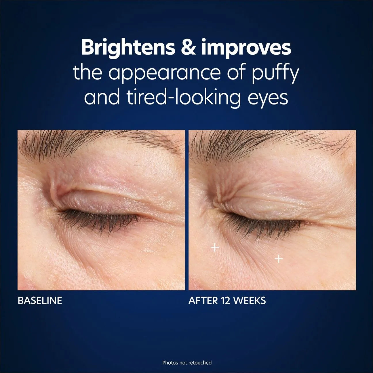 Hyaluronic Acid Microneedle Eye Patches