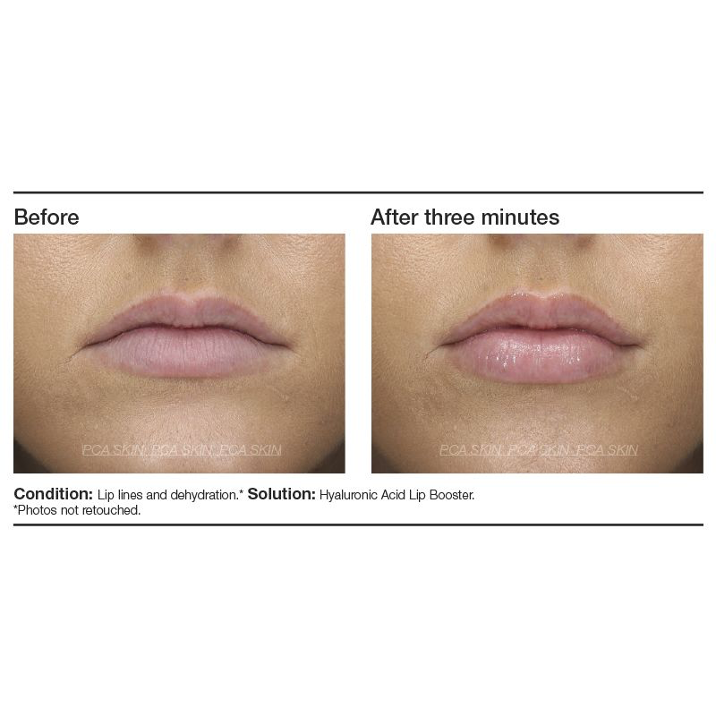 Hyaluronic Acid Lip Booster