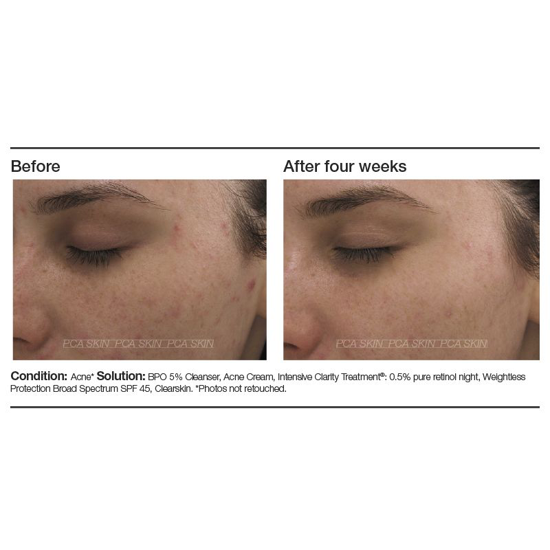 Intensive Clarity Treatment: 0.5% Pure Retinol